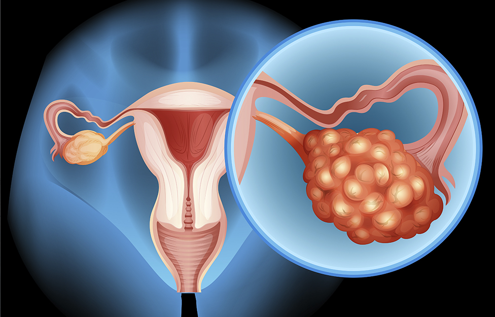Ovarian cancer rivera maya.jpg